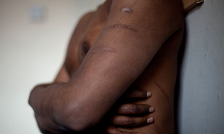 Sri Lankan Tamil torture victim | File photo